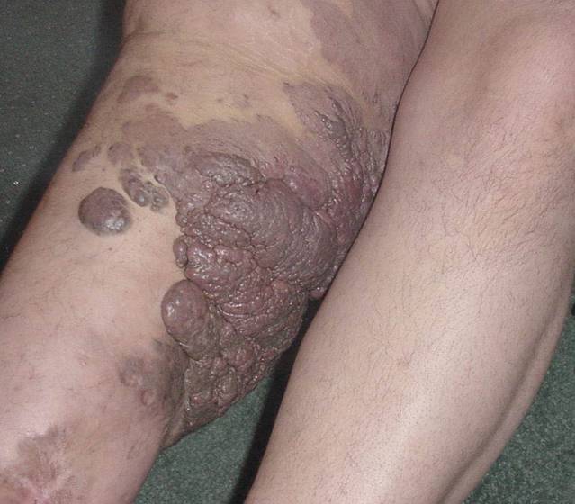 Vascular malformations on a leg.